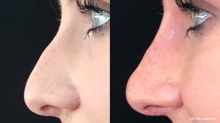Non-surgical rhinoplasty cost: Reshaping your nose without downtime