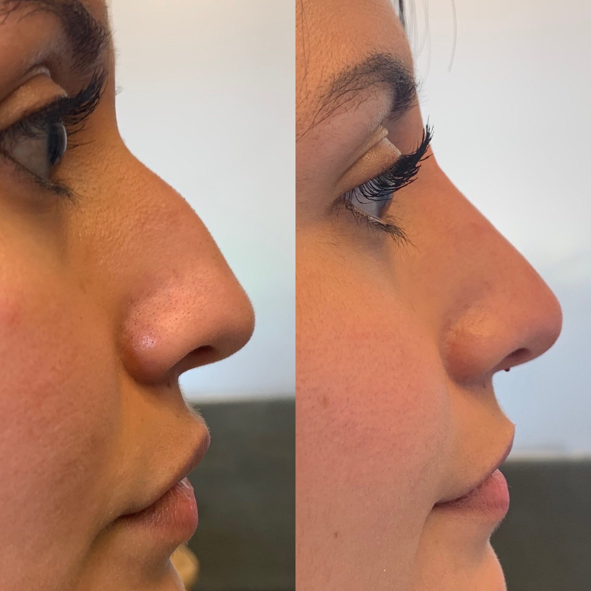 non surgical rhinoplasty cost