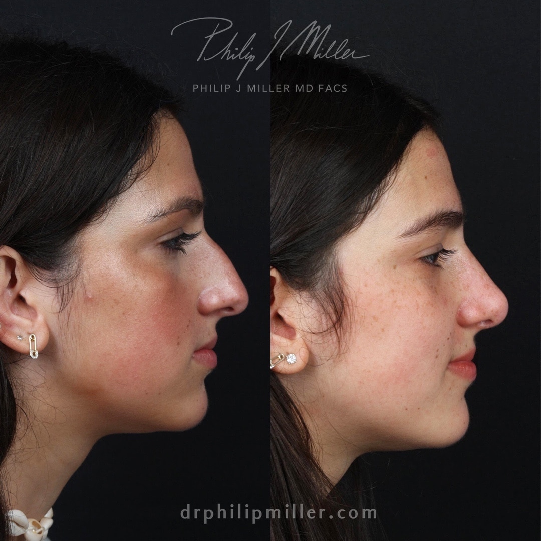 non surgical rhinoplasty non surgical rhinoplasty
