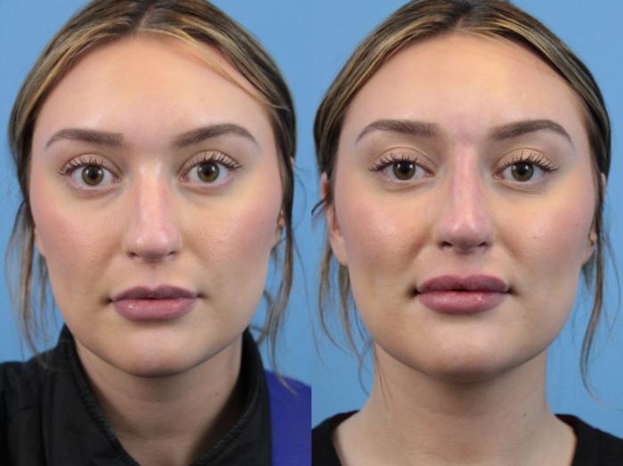 non surgical rhinoplasty non surgical rhinoplasty