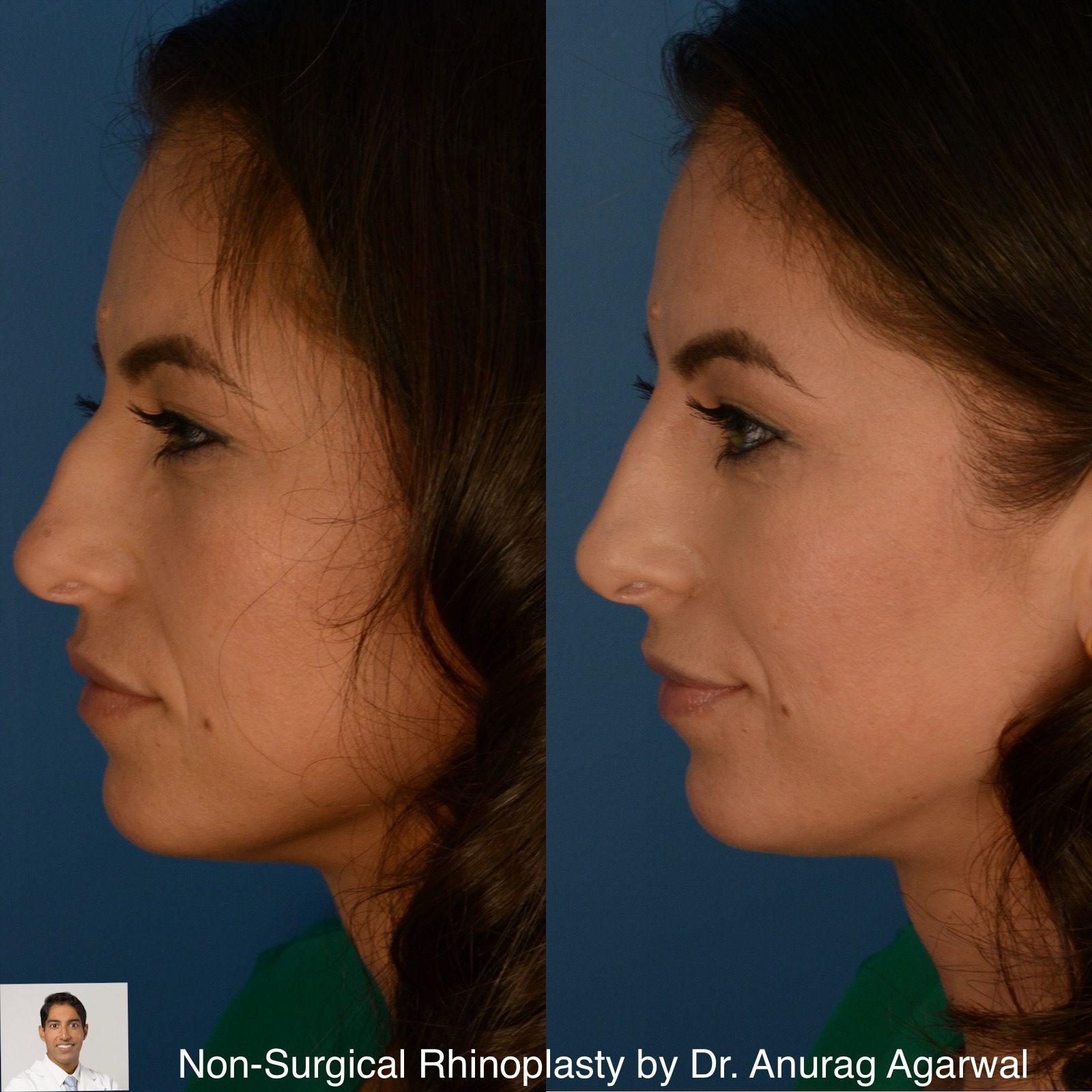 non surgical rhinoplasty non surgical rhinoplasty