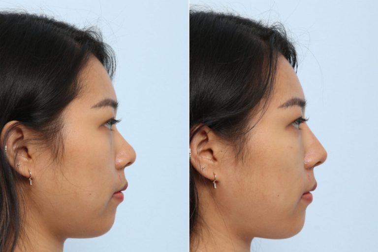 Non-surgical rhinoplasty: Reshaping your nose without downtime
