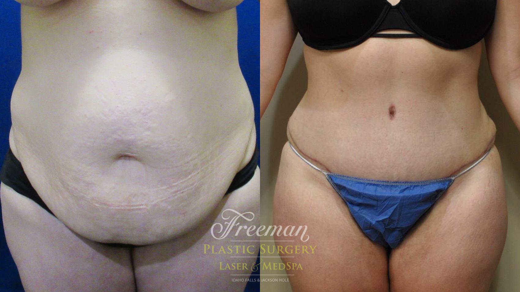 non surgical tummy tuck cost