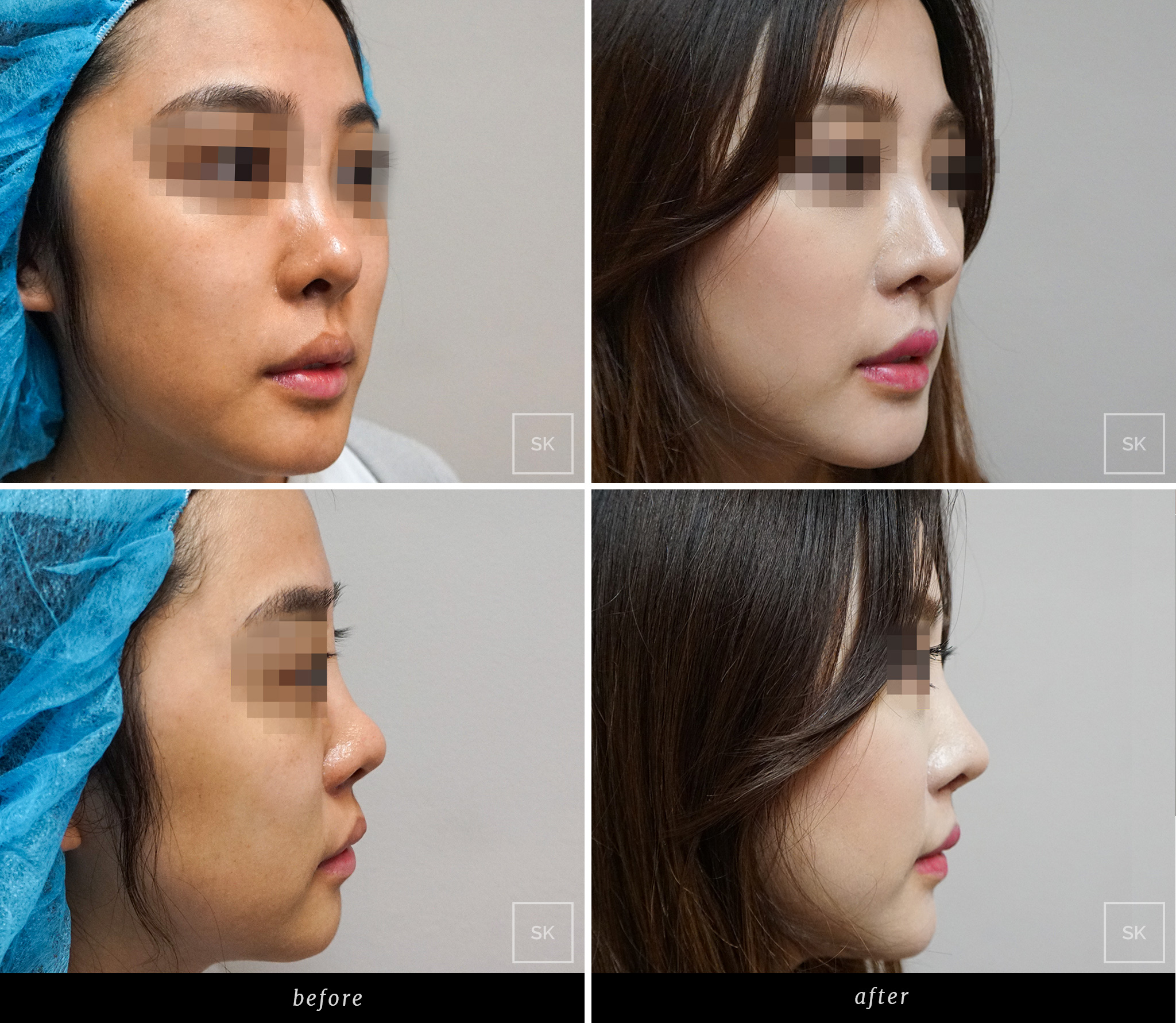 nose augmentation nose augmentation
