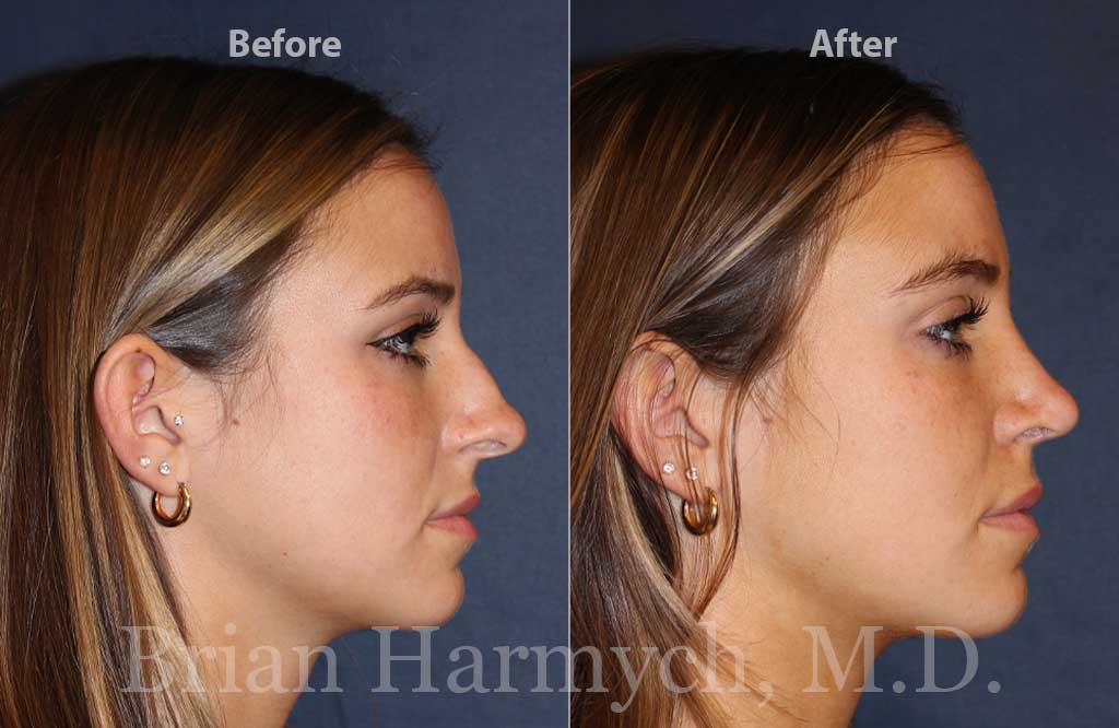 nose augmentation nose augmentation