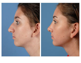 Nose augmentation: Enhancing form and function