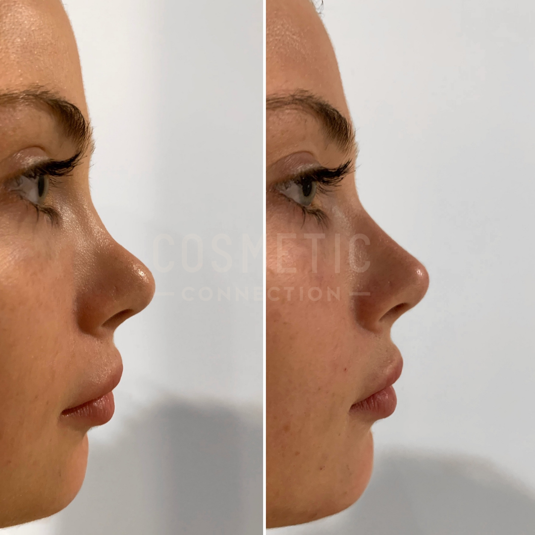 nose augmentation nose augmentation