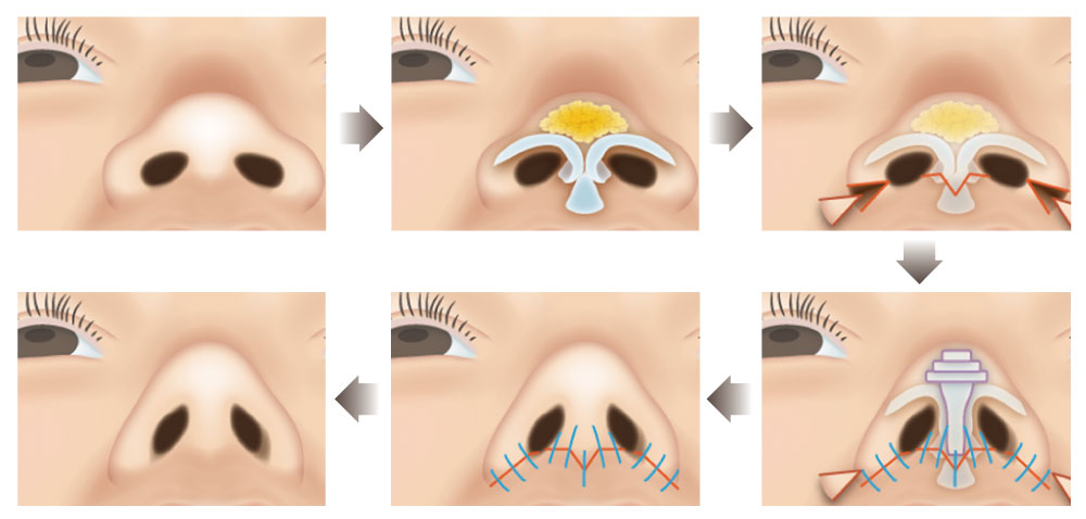 nose fat removal