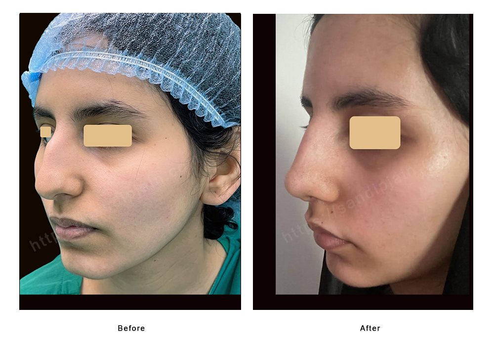 nose fat removal