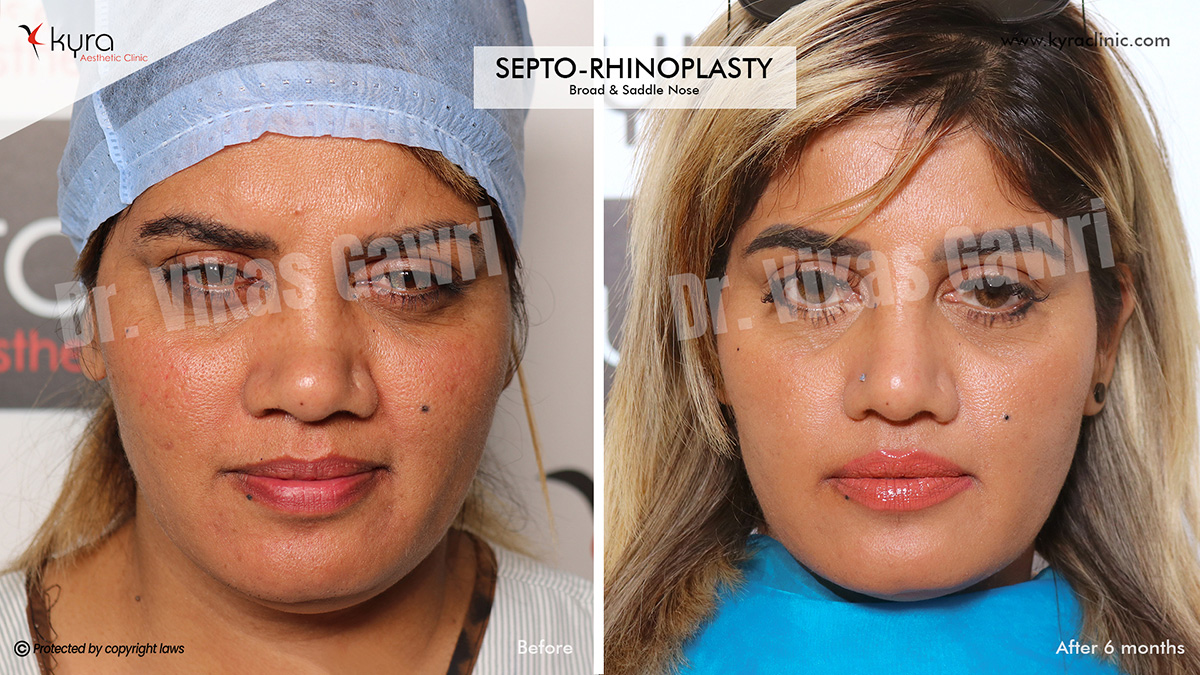 nose fat removal