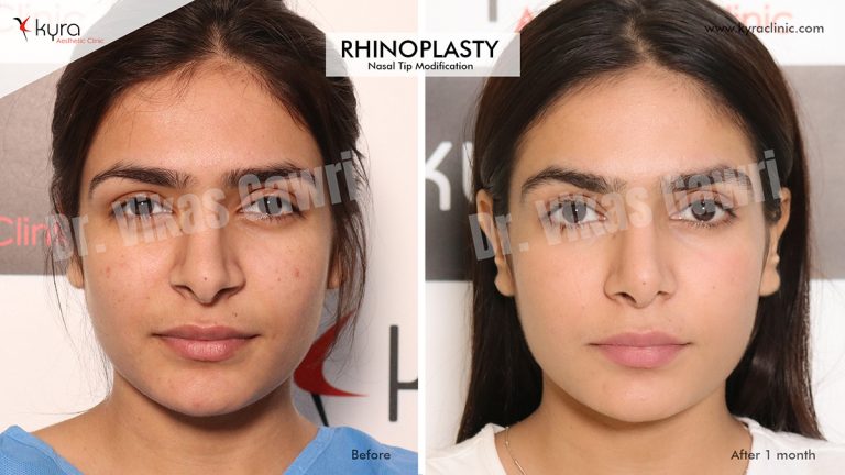 Nose fat removal: Refining the appearance of the nasal area