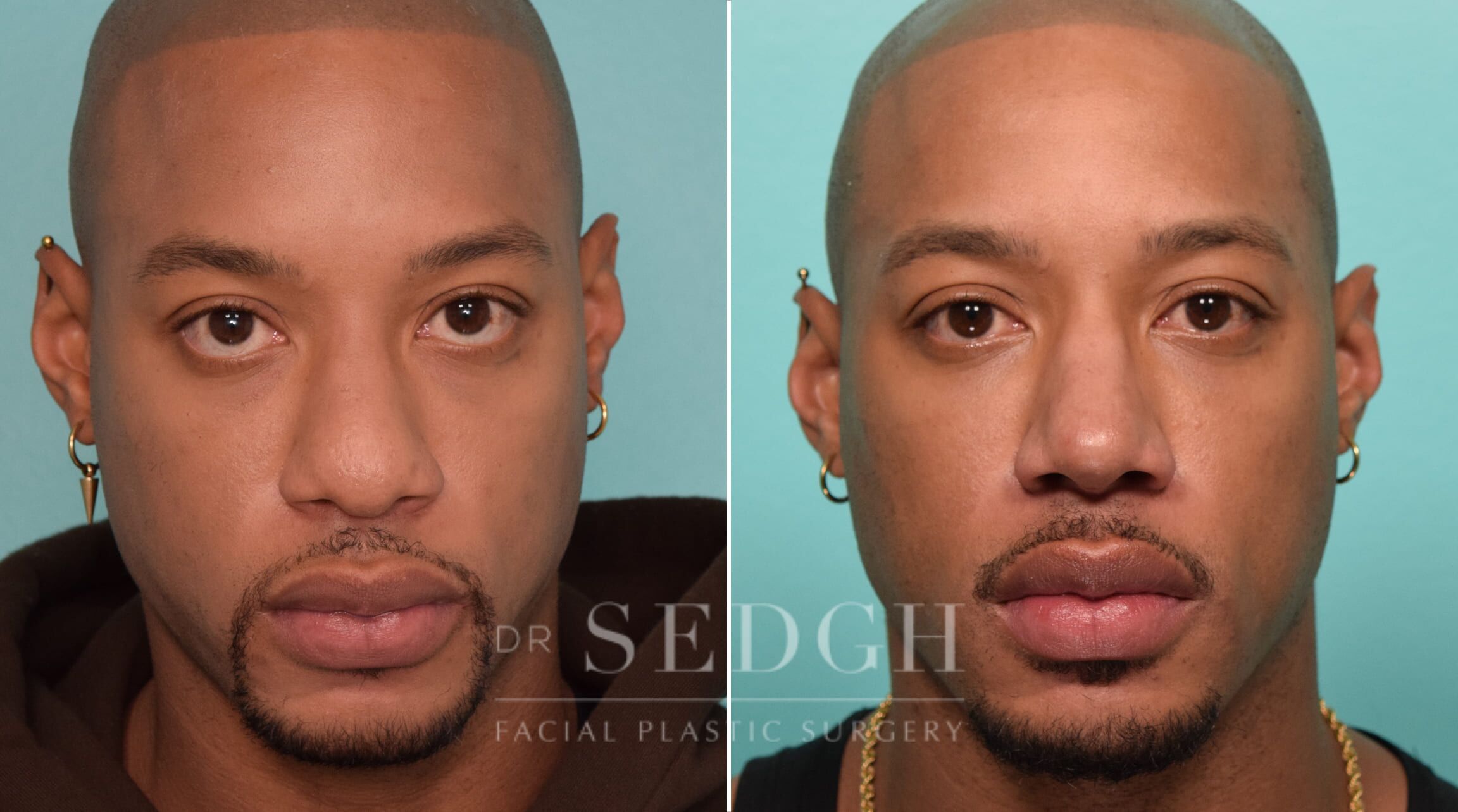 nose job men nose job men