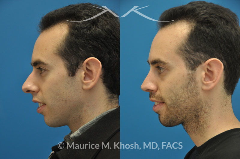 nose job men nose job men