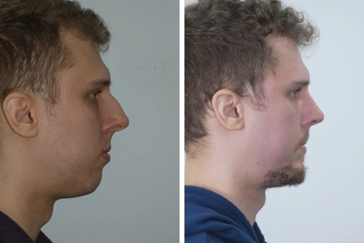 nose job men nose job men