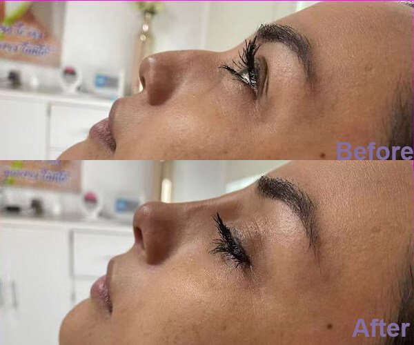 nose lift
