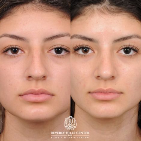 nose lift
