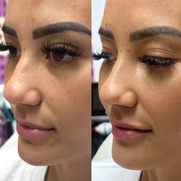 Nose lift: Subtle changes for a more refined profile