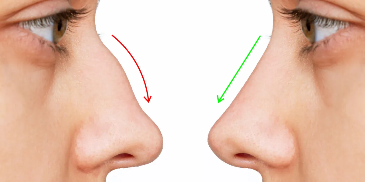 nose lift