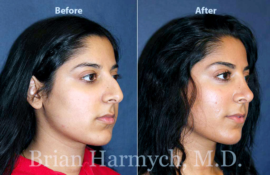 nose plastic surgery cost