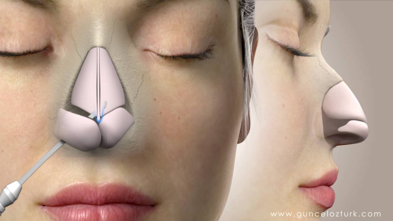 nose plastic surgery nose plastic surgery
