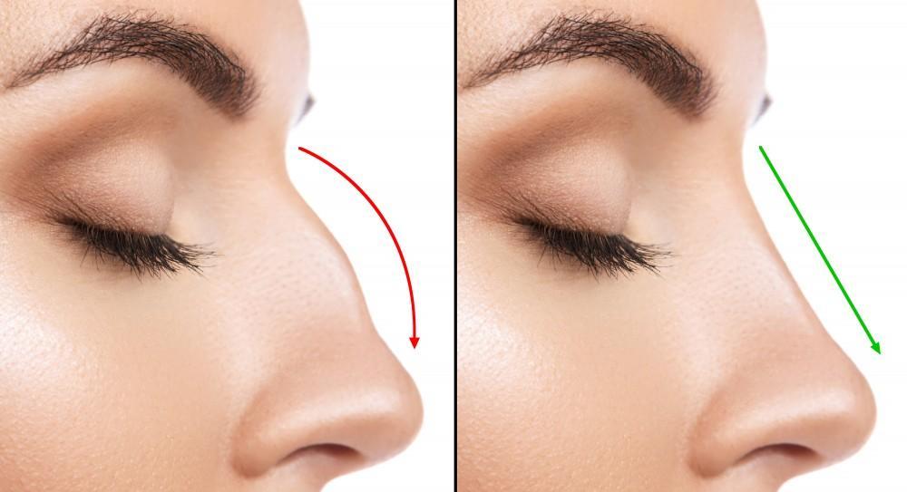 nose plastic surgery nose plastic surgery