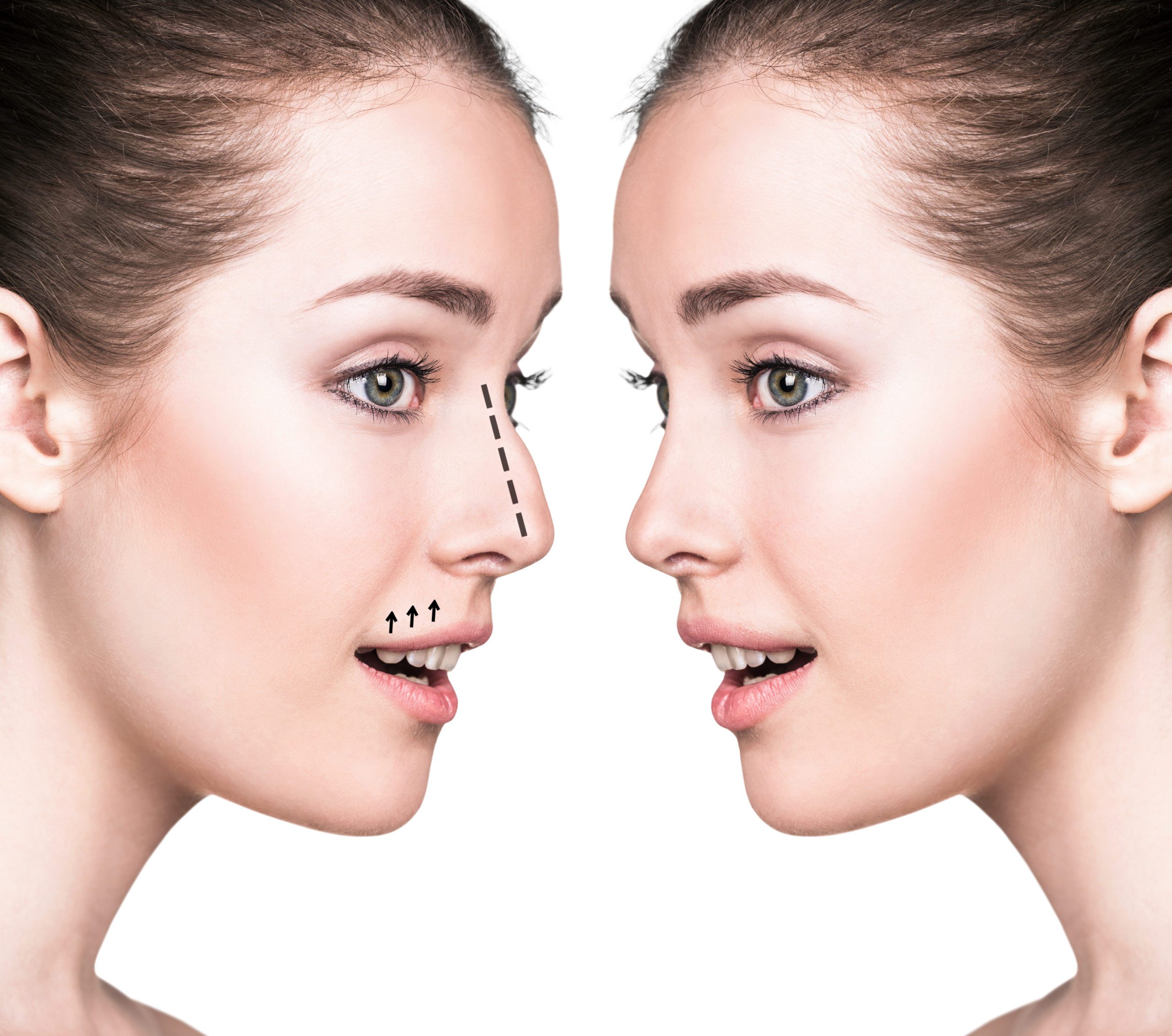nose plastic surgery nose plastic surgery