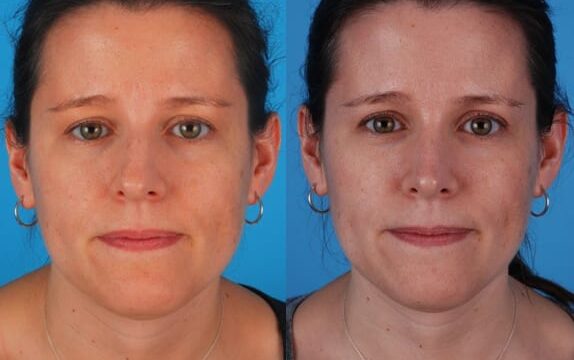 nose reconstruction surgery nose reconstruction surgery
