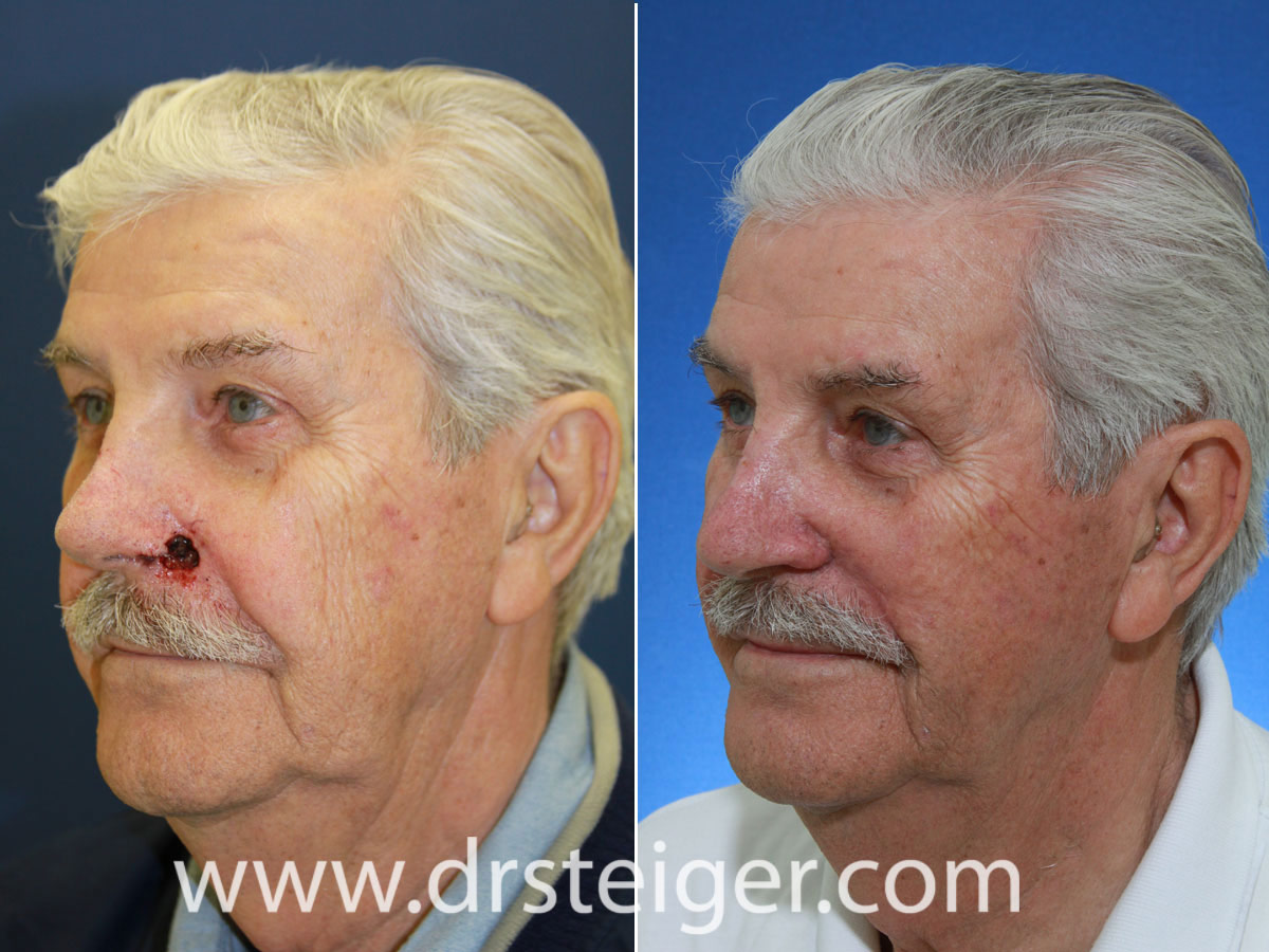 nose reconstruction surgery nose reconstruction surgery