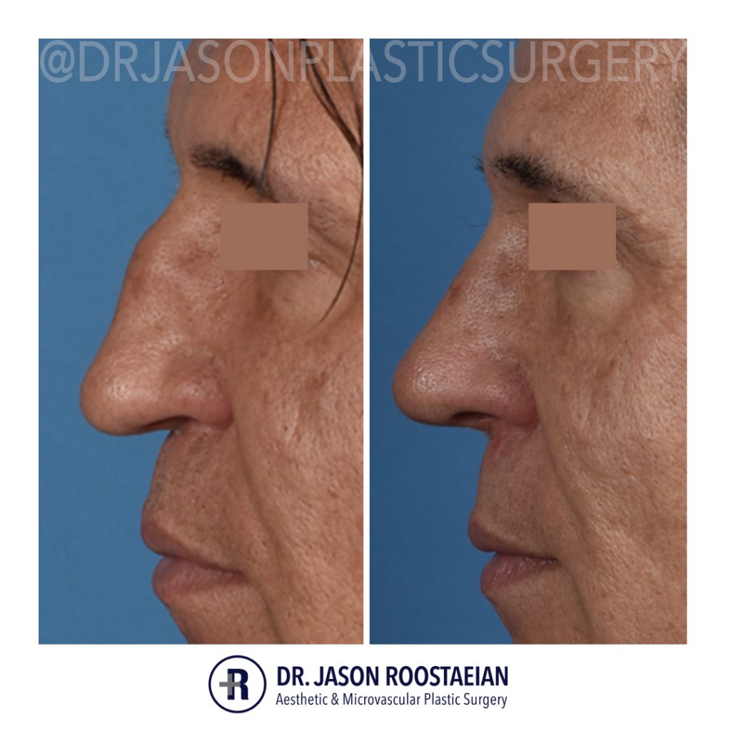 nose reconstruction surgery nose reconstruction surgery