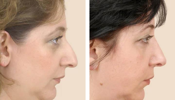 Nose Reconstruction Surgery: Restoring function and aesthetics