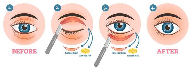 oculoplastic
