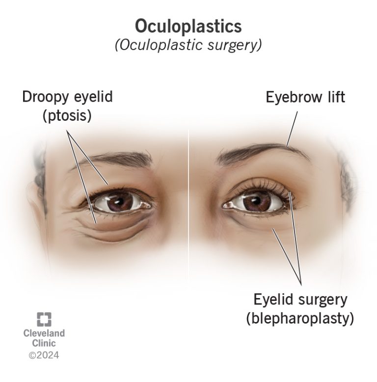 Oculoplastic surgery: Enhancing the eyes and surrounding areas