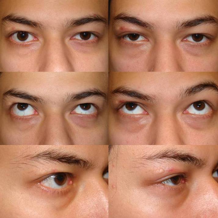 ophthalmic plastic surgery