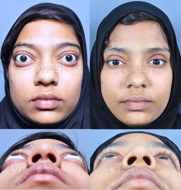 ophthalmic plastic surgery