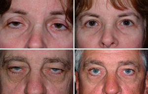 Ophthalmic plastic surgery: Specialized care for the eye area