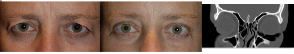 ophthalmic plastic surgery