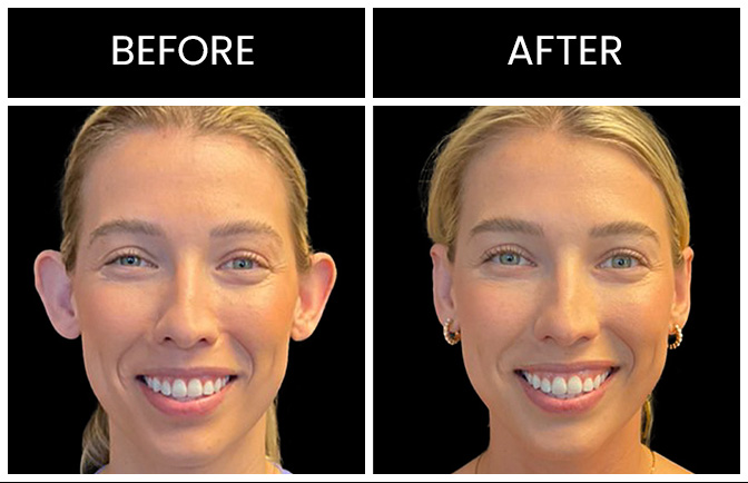 otoplasty