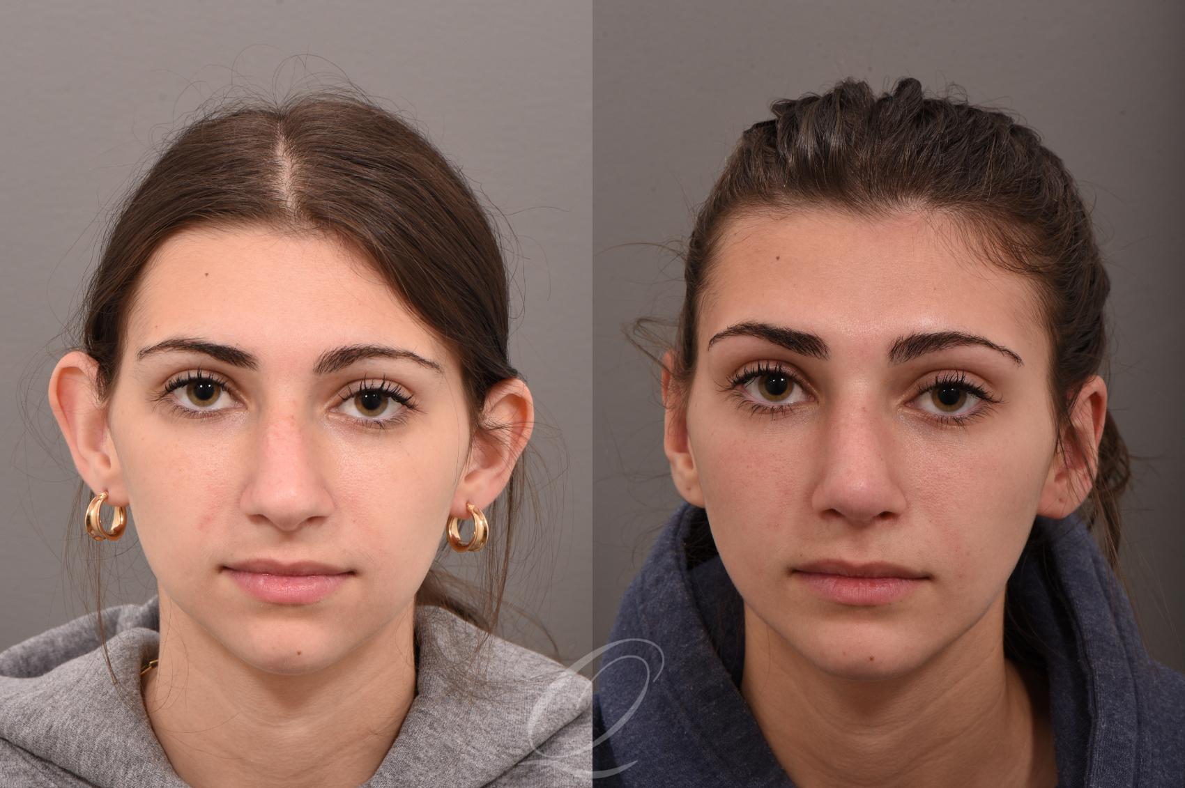 otoplasty
