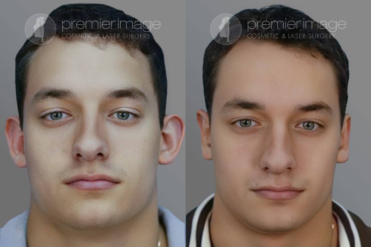 otoplasty