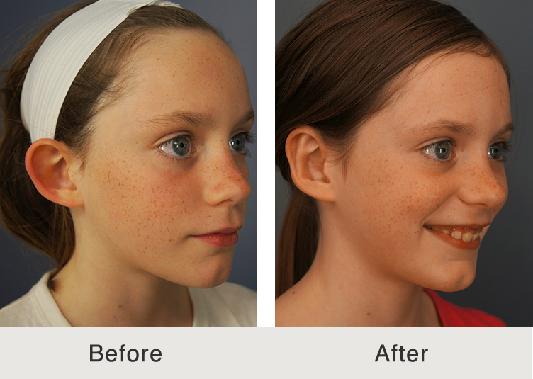 Otoplasty: Ear reshaping with care