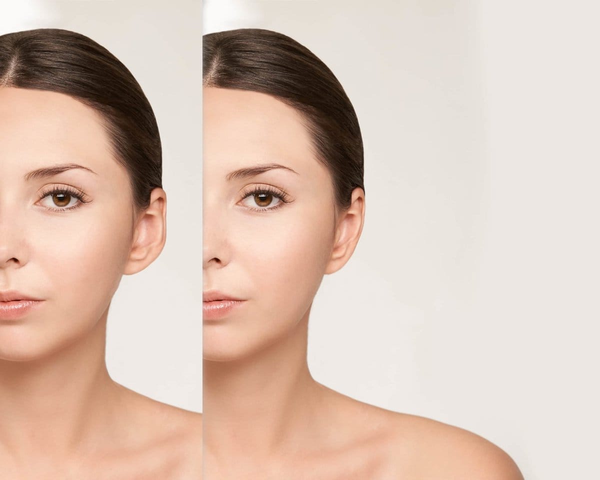 otoplasty surgery
