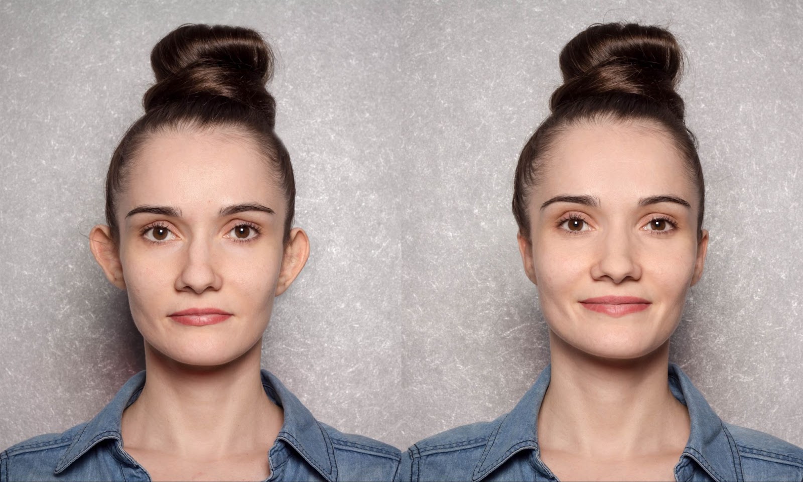 otoplasty surgery