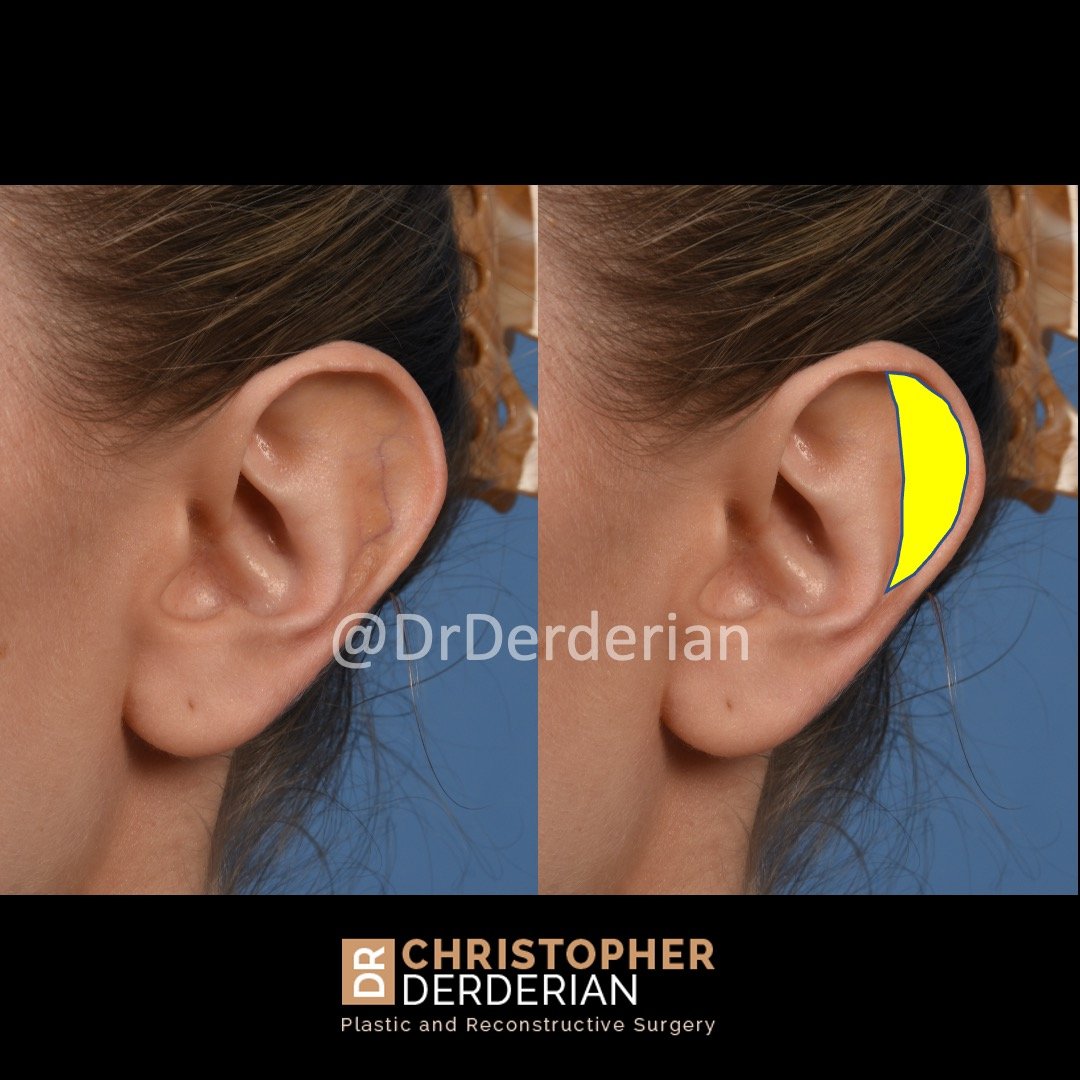 otoplasty surgery