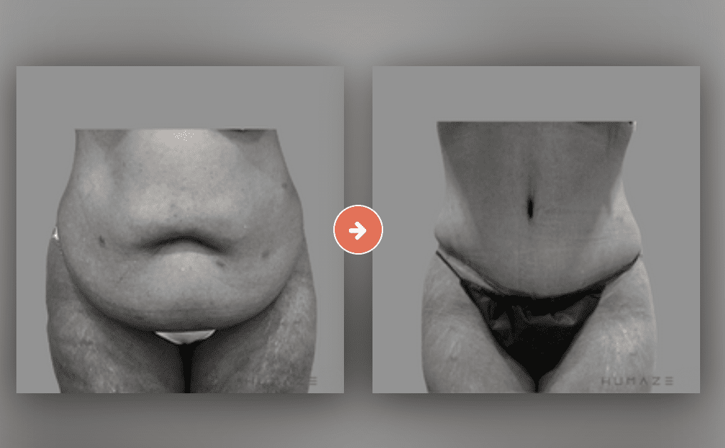 panniculectomy cost
