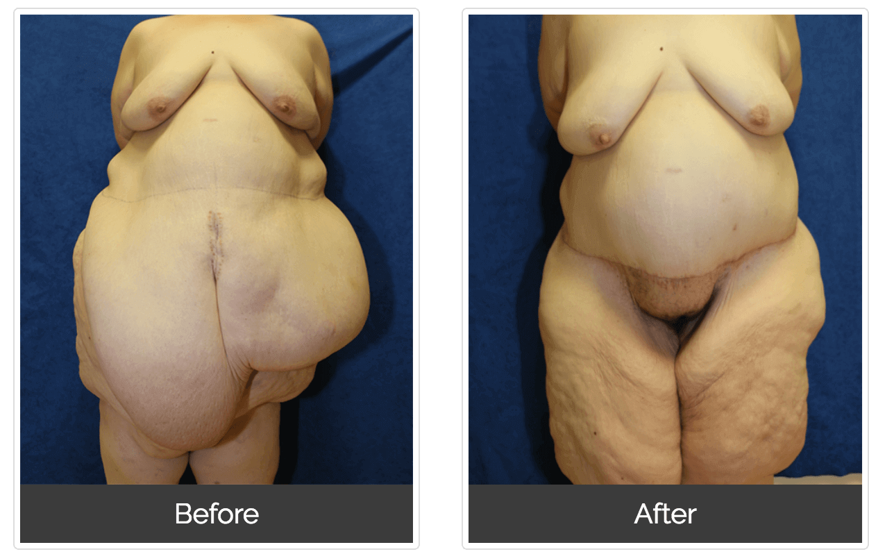 panniculectomy surgery panniculectomy surgery