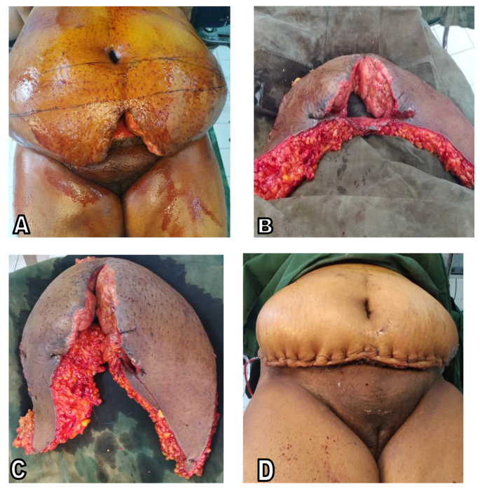 panniculectomy surgery panniculectomy surgery