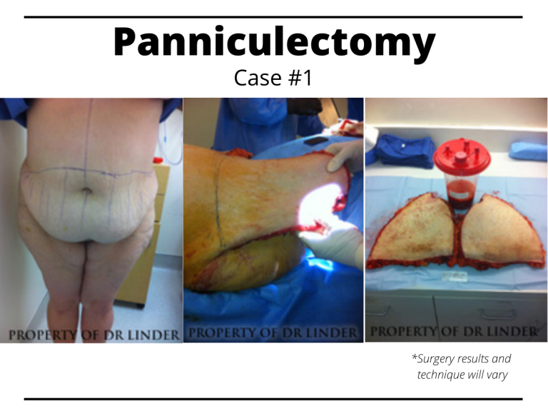 Panniculectomy Surgery: Removing excess abdominal skin