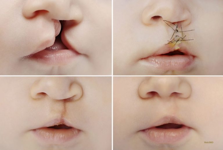 Pediatric Plastic Surgery: Special Considerations for Young Patients