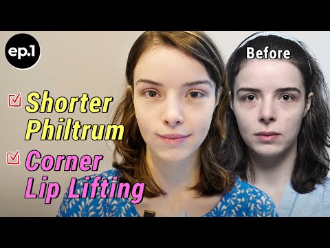 philtrum reduction