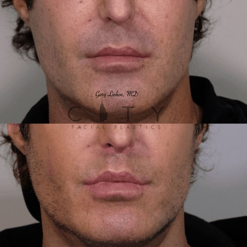 philtrum reduction